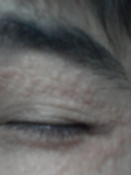 prednisone coverage prednisone coverage
