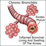 bronchitis infection medicine