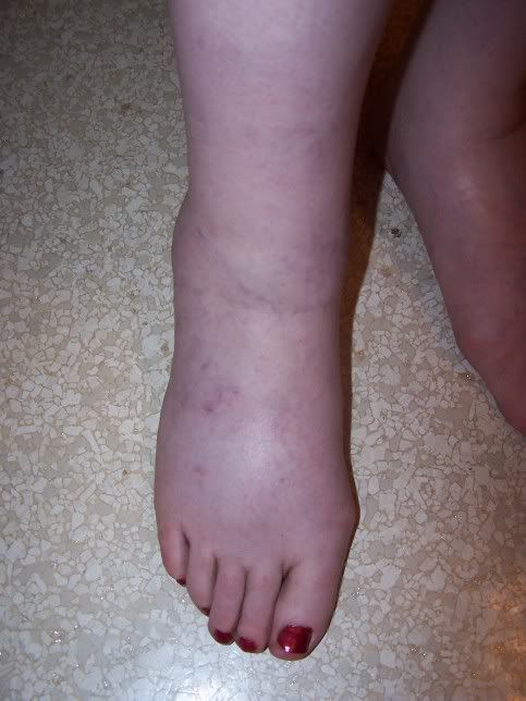 Preeclampsia Feet Swelling